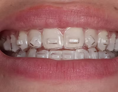 Alinhadores Ortodônticos