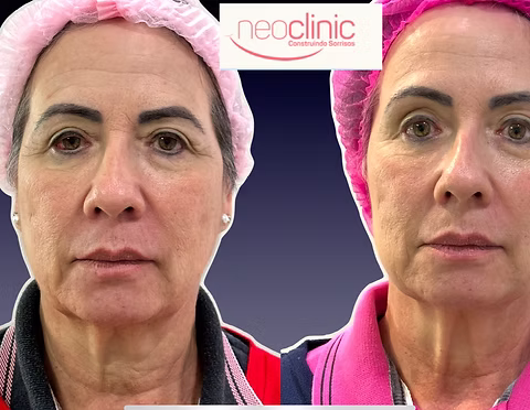 Bioestimulador de colágeno